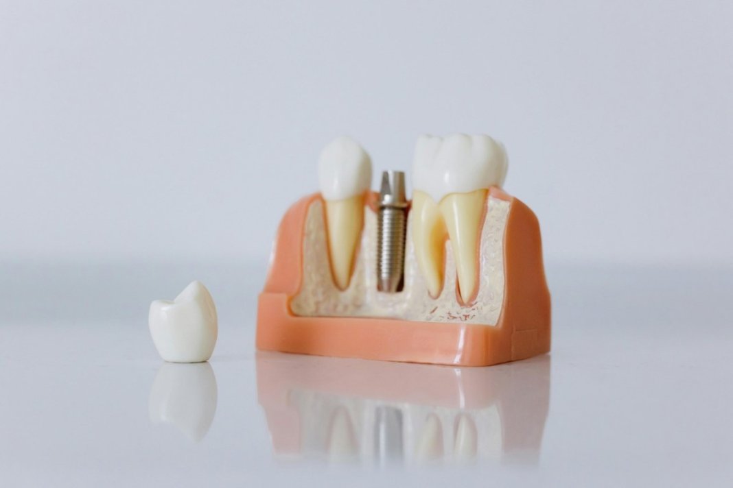 Cat-costa-un-implant-dentar-si-de-ce-pretul-difera-de-la-un-pacient-la-altul Cat-costa-un-implant-dentar-si-de-ce-pretul-difera-de-la-un-pacient-la-altul